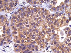Photo 2 is on the left and a G1P3 Overexpression in Early Stage Breast Cancer.